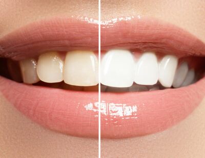 Teeth Restoration Tips For Whiter, Brighter Smile