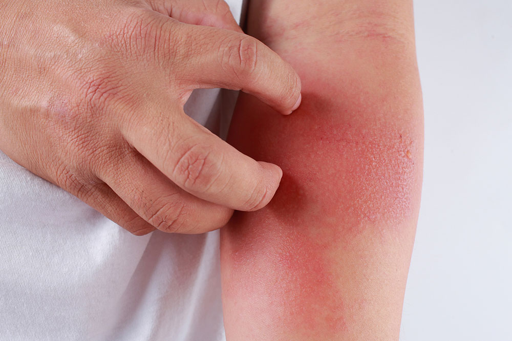 8 American Cities That Can Aggravate Eczema Symptoms