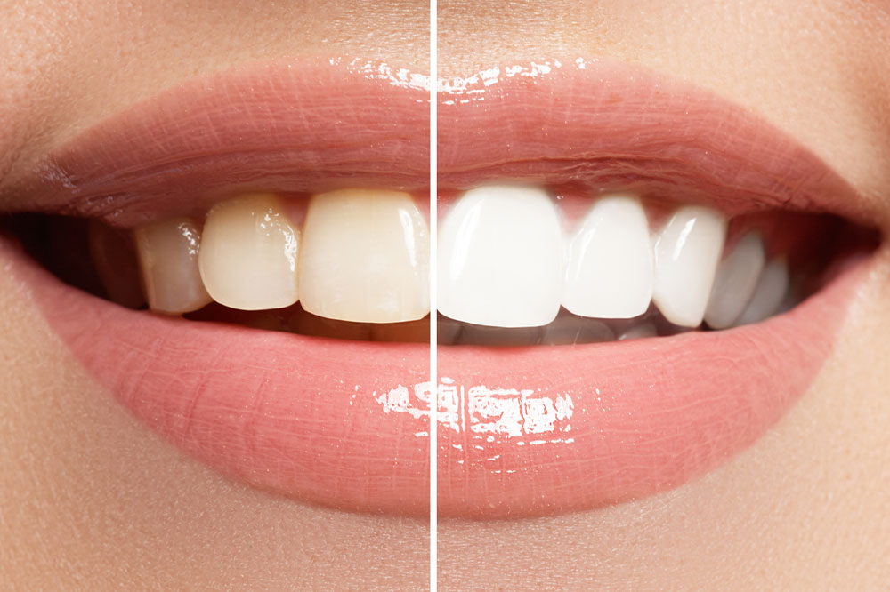 Teeth Restoration Tips For Whiter, Brighter Smile