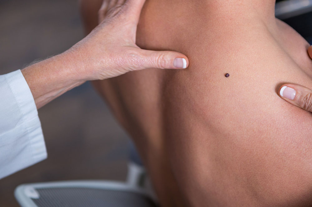 Melanoma &#8211; Its Prevention, Symptoms, and Treatments